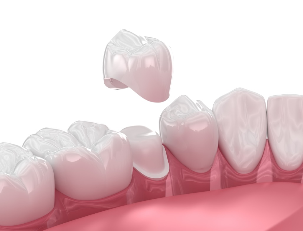 What Is Dental Plaque? - Northern Dental Design